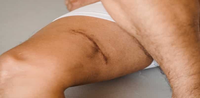 thigh injury compensation