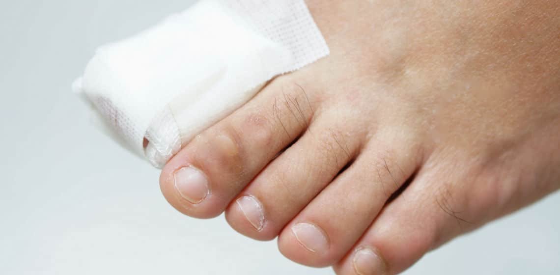 broken toe compensation claims