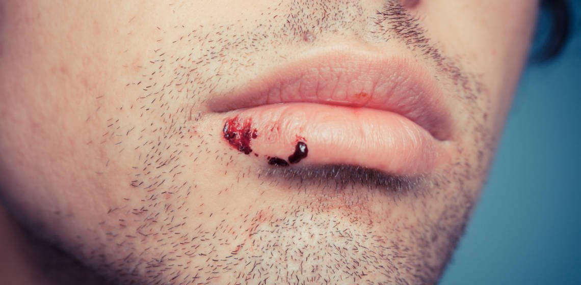lip injury claims